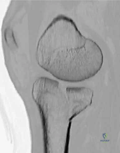 صورة شعاعية توضح التداخل التشريحي المعقد في كسور الركبة