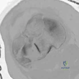 توضيح لآلية الكسر ثنائي اللقمة وانفصال الشظايا