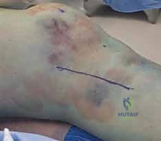 تطبيق التثبيت الخارجي المؤقت لحماية الأنسجة الرخوة