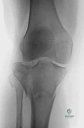 تأثير القوى المحورية على تشريح مفصل الركبة