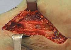 صورة توضيحية لـ كسور الهضبة الظنبوبية ثنائية اللقمة: دليل شامل للعلاج والتعافي مع الأستاذ الدكتور محمد هطيف