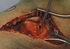 صورة توضيحية لـ كسور الهضبة الظنبوبية ثنائية اللقمة: دليل شامل للعلاج والتعافي مع الأستاذ الدكتور محمد هطيف