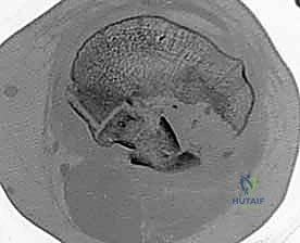 Masterclass: Open Reduction and Internal Fixation of Bicondylar Tibial Plateau Fractures
