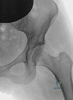 تشريح الحوض ومفصل الورك قبل جراحة قطع العظم