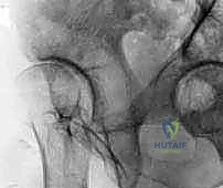 تقييم حالة مفصل الورك بالأشعة