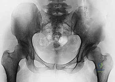 التشريح الدقيق لمفصل الورك