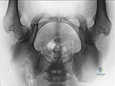 التخطيط المسبق للعملية الجراحية