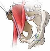 صورة توضيحية لـ جراحة قطع العظم حول الحُق