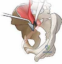 خطوات جراحية إضافية