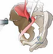 تثبيت العظم بالمسامير الطبية