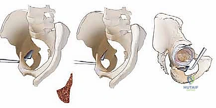 مراحل التثبيت الداخلي