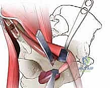 التصوير الشعاعي أثناء العملية