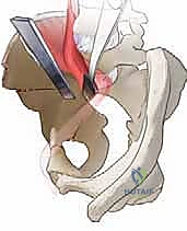 التحقق من التغطية المثالية لرأس الفخذ