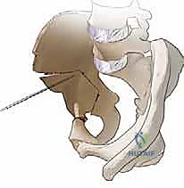 Intraoperative Surgical Step