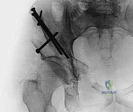 Illustration of anterosuperior iliac spine - Dr. Mohammed Hutaif
