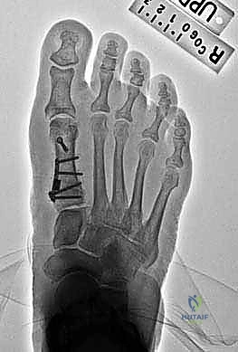 Proximal Metatarsal Opening Wedge Osteotomy: A Masterclass in Hallux Valgus Correction