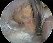 Illustration of release of nerve - Dr. Mohammed Hutaif