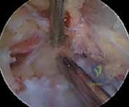 صورة منظارية توضح قطع الرباط وتحرير العصب بنجاح