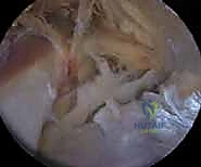 تحرير العصب فوق الكتفي بالمنظار: دليل شامل لعلاج انحباس العصب الكتفي واستعادة قوة الكتف