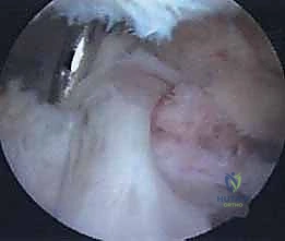 الأسباب الشائعة لانضغاط العصب وتكون الأكياس العقدية