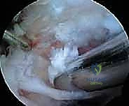 التشخيص الإشعاعي والرنين المغناطيسي لانحباس العصب الكتفي