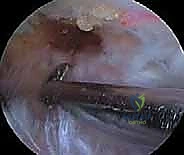 خطوات تحرير العصب فوق الكتفي بالمنظار الجراحي