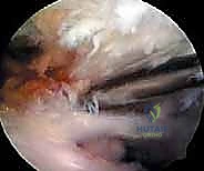 التشريح الدقيق للعصب فوق الكتفي ومساره في الكتف