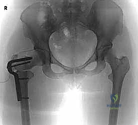 صورة توضيحية لـ عملية قطع عظم الفخذ بين المدورين: حل جذري لتشوهات الورك والحفاظ على المفصل