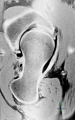 صورة شعاعية توضح تشوه مفصل الورك قبل الجراحة