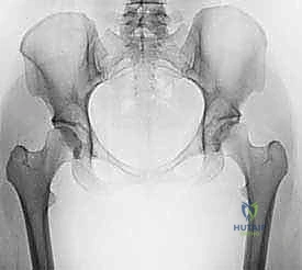 تخطيط ما قبل الجراحة لعملية قطع عظم الفخذ