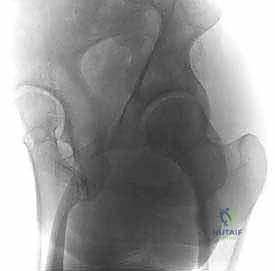 تقييم الأعراض السريرية ومحدودية الحركة