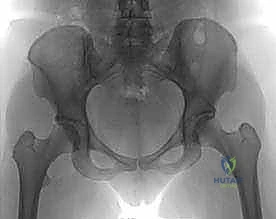 تقييم حالة مفصل الورك قبل التدخل الجراحي
