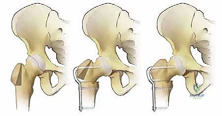 الوصول الجراحي وكشف منطقة بين المدورين