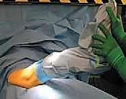 عملية قطع عظم الفخذ بين المدورين: حل جذري لتشوهات الورك والحفاظ على المفصل