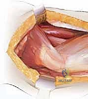 إجراء القطع العظمي بدقة بالغة