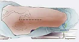 إدخال السلك الدليلي تحت توجيه الأشعة