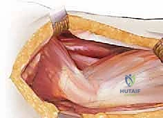 التخطيط الهندسي الدقيق لزوايا القطع العظمي