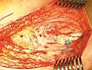 تثبيت العظم باستخدام الشريحة والمسامير