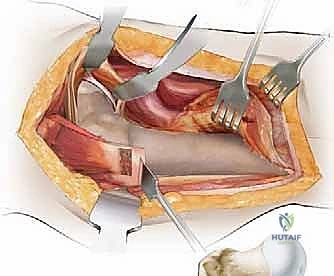 صورة شعاعية توضح التئام العظم بعد عدة أشهر من الجراحة
