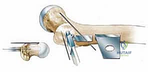 تأكيد الوضعية النهائية للعظم والشريحة