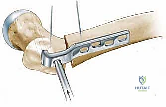 صورة توضيحية لـ عملية قطع عظم الفخذ بين المدورين: حل جذري لتشوهات الورك والحفاظ على المفصل