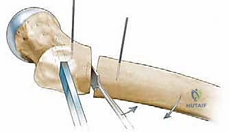 Intraoperative Surgical Step