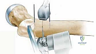 بدء جلسات العلاج الطبيعي والتأهيل