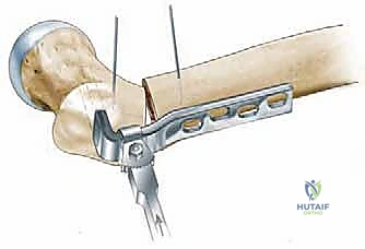 توجيه الشريحة المعدنية بدقة متناهية