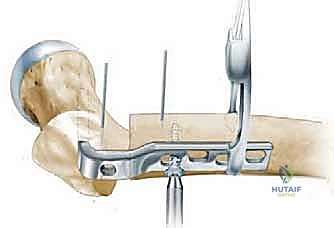 Illustration of femoral osteotomy femoral - Dr. Mohammed Hutaif