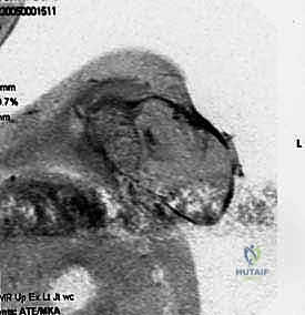 التشريح المعقد لحزام الكتف