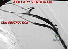 صورة طبية: استئصال الربع الأمامي: دليل شامل للمرضى مع الأستاذ الدكتور محمد هطيف