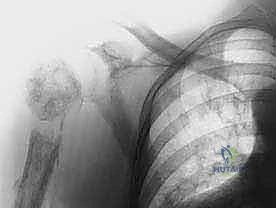 الفحص السريري للكتلة الورمية