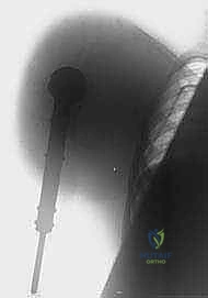 صور أشعة تظهر ورماً متقدماً في الكتف