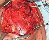 صورة طبية: استئصال الربع الأمامي: دليل شامل للمرضى مع الأستاذ الدكتور محمد هطيف